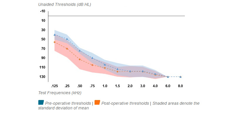 Average Pre vs. Post-op hearing thresholds